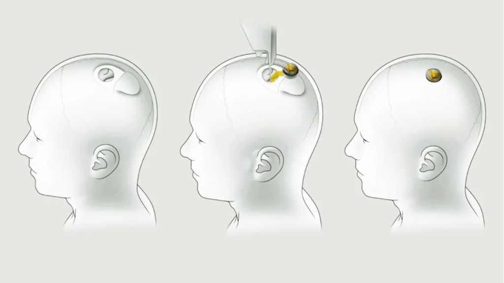How the Neuralink implant works